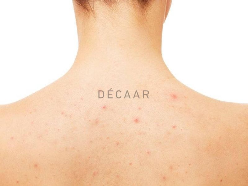 Cần lưu ý một số điều sau để đạt hiệu quả điều trị mụn lưng